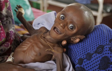 29bin çocuk açlıktan öldü