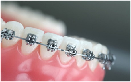 Diş Teli Yaptırmak İçin Diş Çekilir Mi?