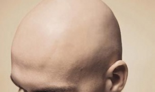 Erkeklerde Saç Dökülmesini Durdurmak Nasıl Olur?