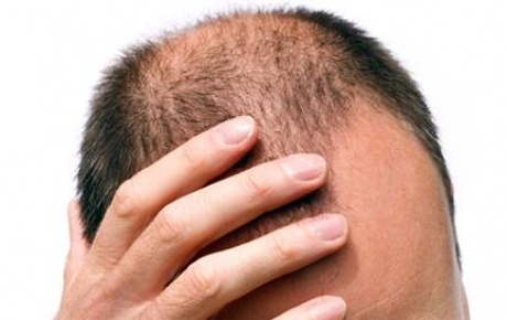 Saç Ekimi Sonrası Terleme Ekilen Saçlara Zarar Verir mi?